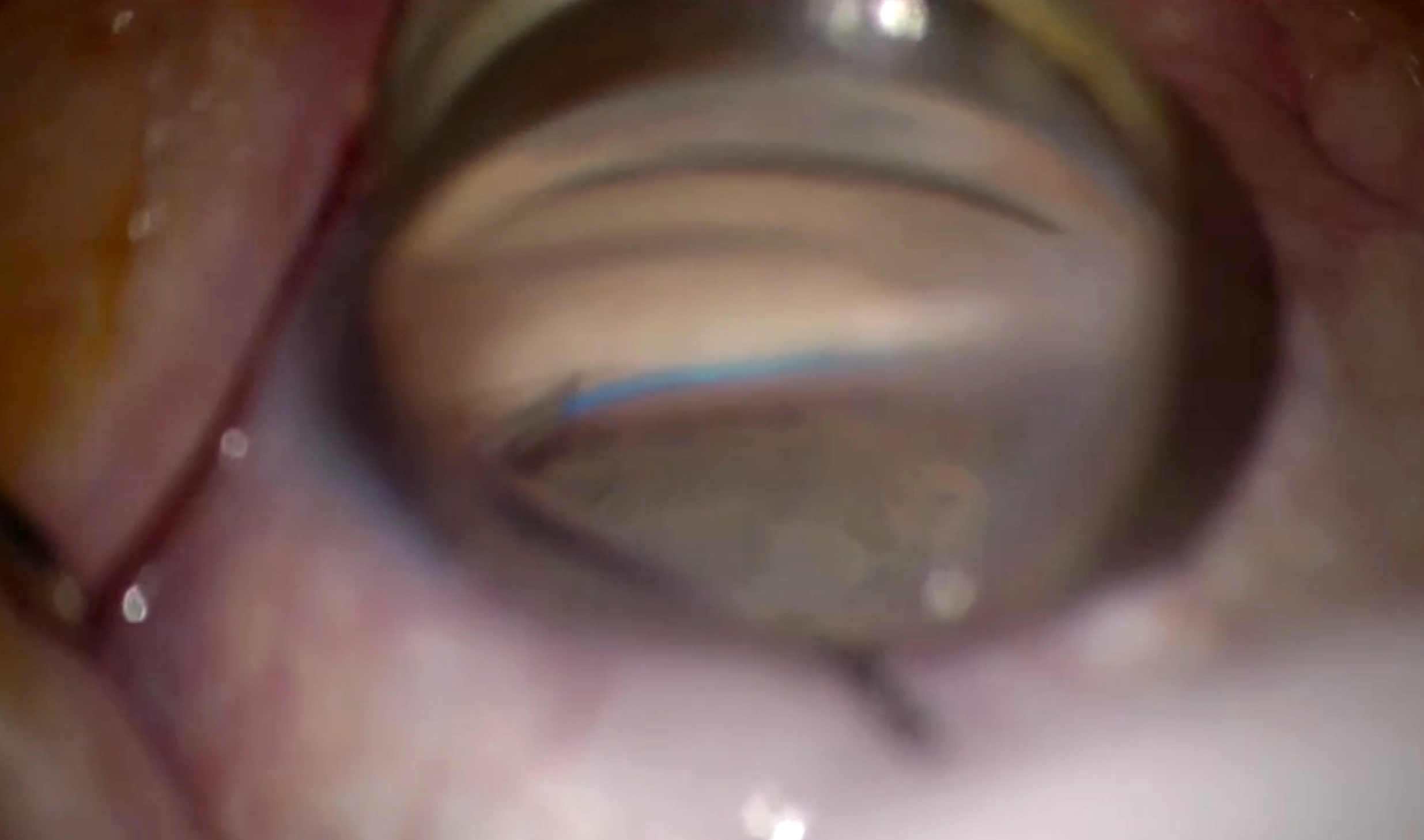 Higher baseline IOP and glaucoma secondary to medications, trauma or inflammation were also risk factors for requiring a subsequent MIGS reoperation such as goniotomy, seen here.