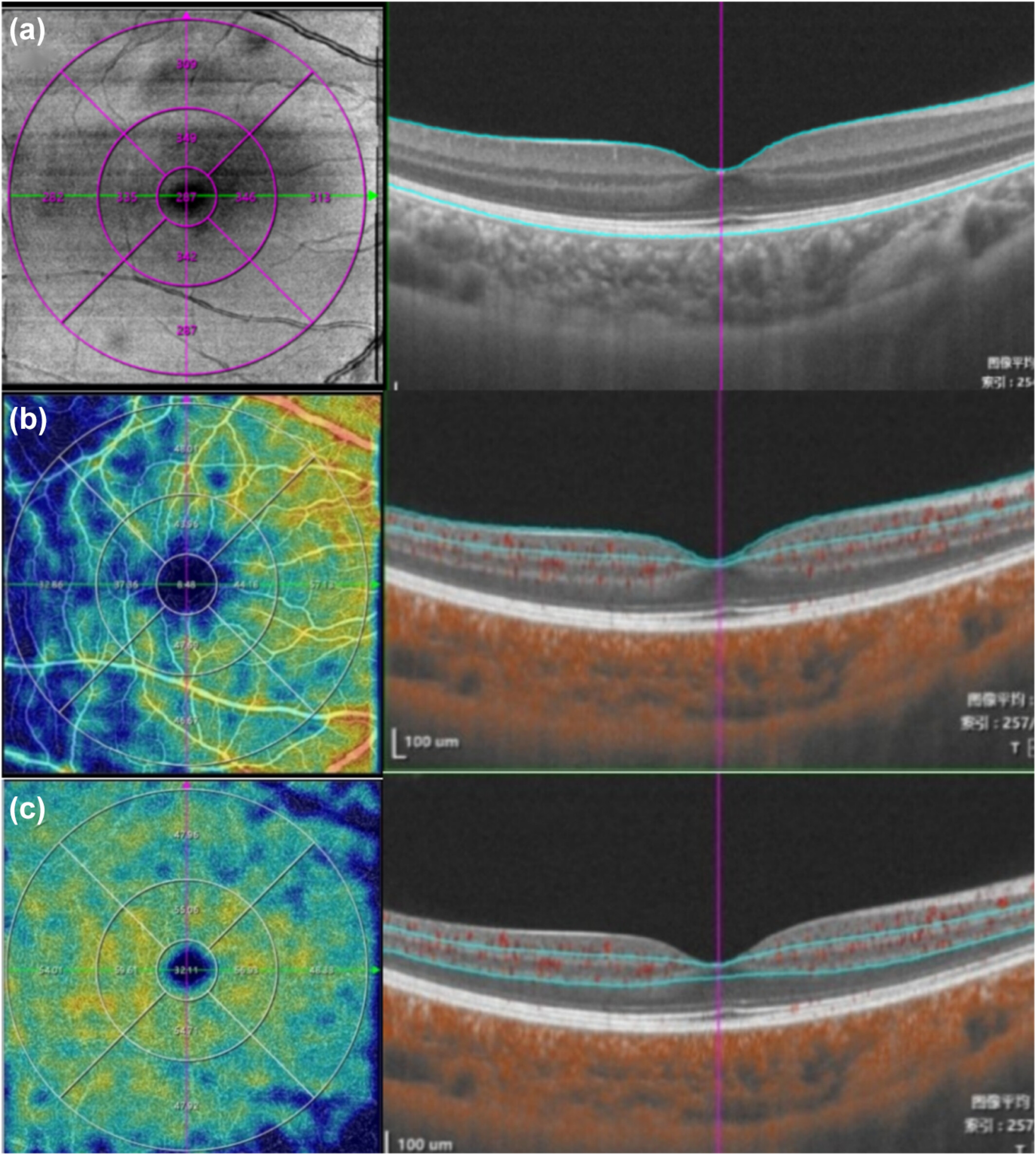 Pediatric axial myopic progression was associated with a decrease in choroidal thickness and retinal thickness in the parafoveal and perifoveal regions, while retinal thickness remained unchanged in the foveal area. This image from the study shows the segmentation of (a) total retinal thickness (b), superficial retinal vascular density and (c) deep retinal vascular density.