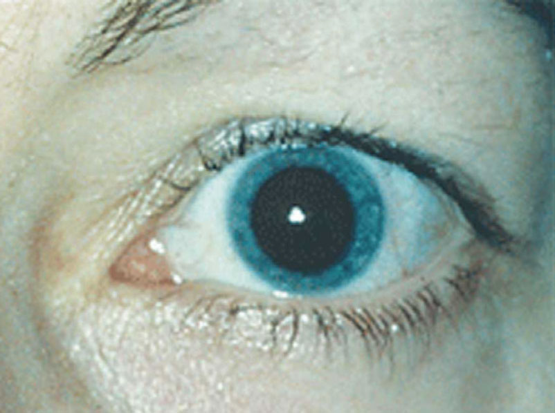 New drugs Mydcombi and Ryzumvi can be used to return dilated pupils to baseline more quickly.