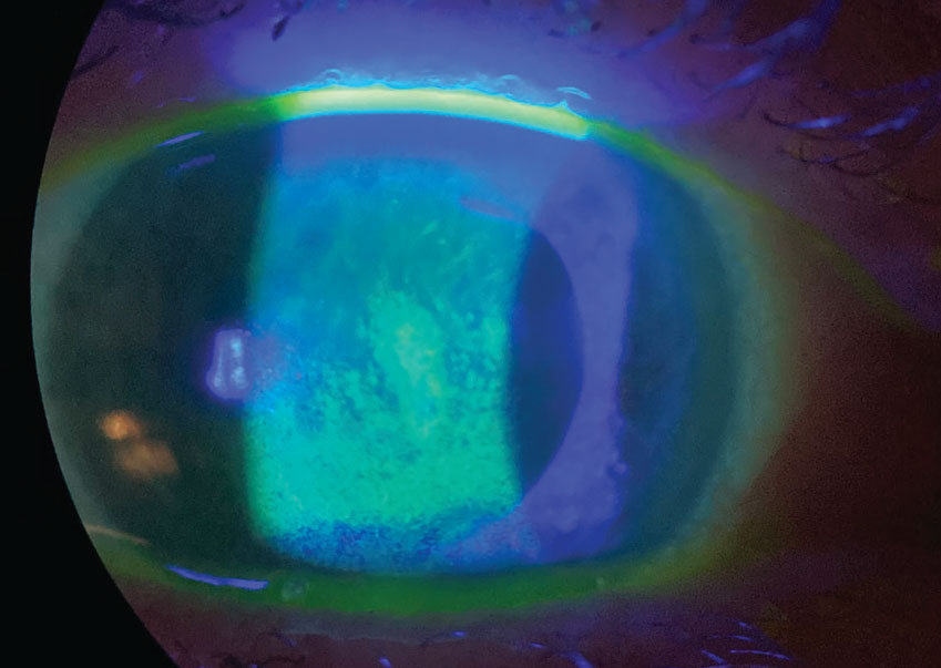 Sodium fluorescein staining reveals a compromised corneal surface due to dry eye. The new Vevye cyclosporine drop should help patients with this condition through improving visual clarity but without the potential for blurring to occur.