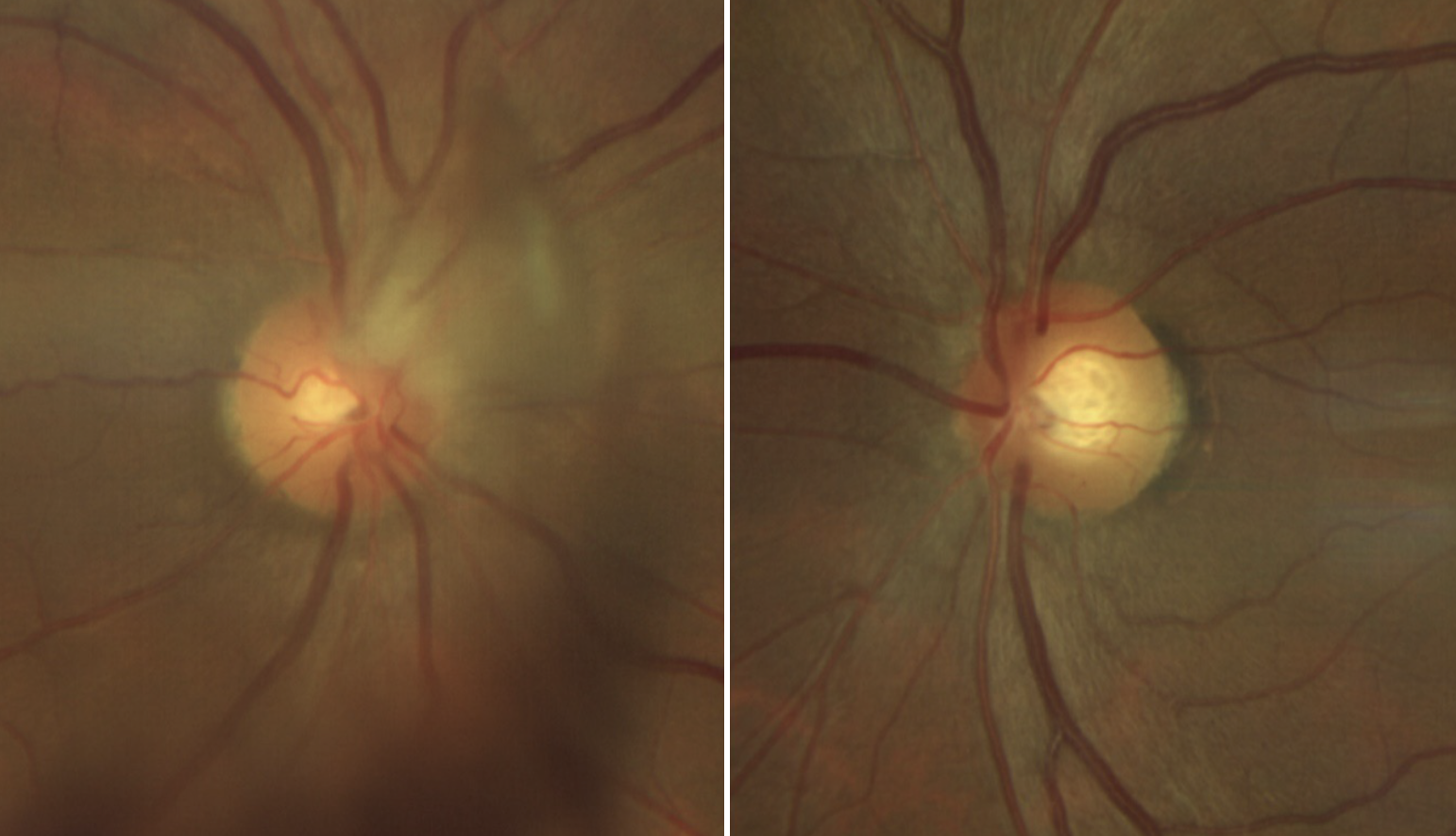 Fig. 1. Right and left optic nerves. The right optic nerve (left image) is seen with blurred and elevated disc margin superonasally. There is also vitreous hemorrhage causing shadowing inferiorly.