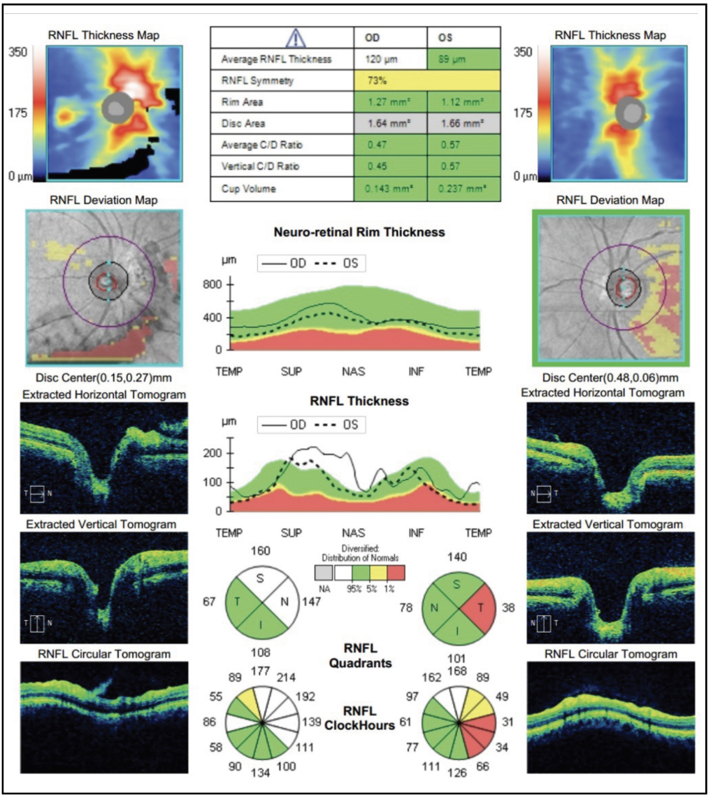 Fig. 2. The OCT of the RNFL is provided. The right optic nerve study reveals thickening of the superior and nasal RNFL. There is some data absent due to hemorrhage blocking signal. The left optic nerve is not elevated; there is unrelated temporal thinning. 