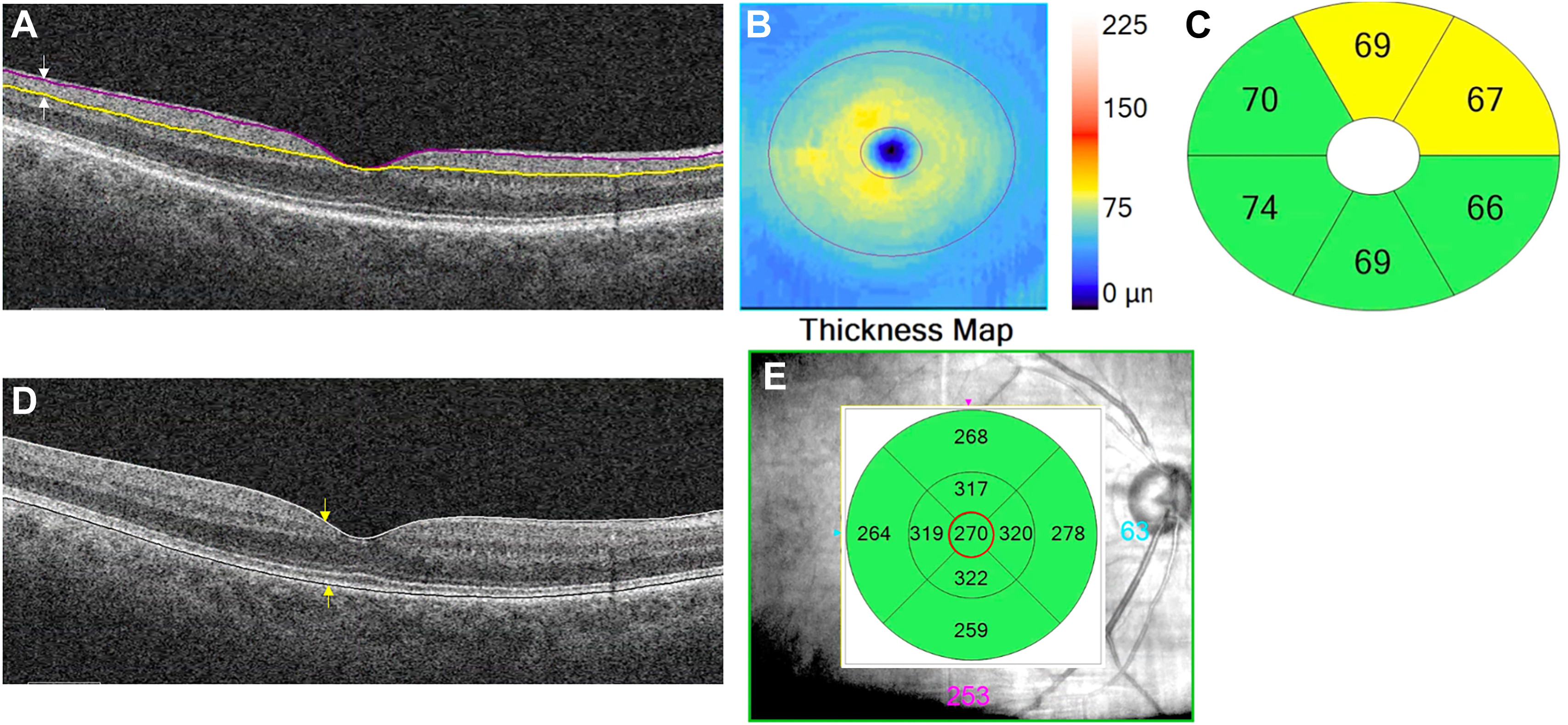 At time of PD diagnosis, generally 50% of dopaminergic input from the substantia nigra to the striatum is lost, which might reflect the dopaminergic state of the retina. This study found small but notable differences in IPL thickness among Parkinson’s patients. (Image from a different study of retinal changes in PD.)