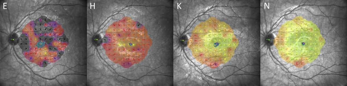 A centrifugal recovery pattern was observed consistently across patients, with faster restoration in the central macula, progression to the extramacular and peripheral regions and culmination around the optic disc. This series from the study (left to right) shows a global reduction in retinal threshold sensitivity by microperimetry at baseline, with darker areas representing deeper scotomata, followed by steady improvements at two weeks, six weeks and three months.