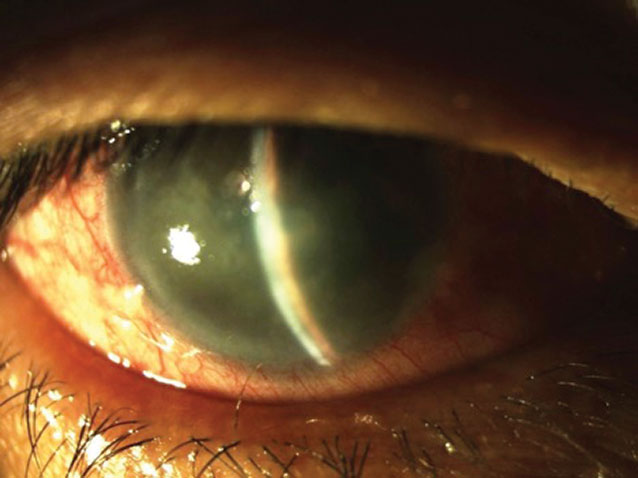 Understanding the mechanisms, risks and management of drug-induced angle-closure glaucoma is vital for patient safety.