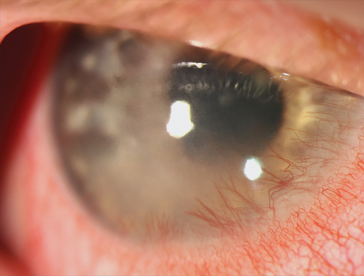 Be mindful of elevated corneal scarring risks in pediatric HKC patients, this research advises.