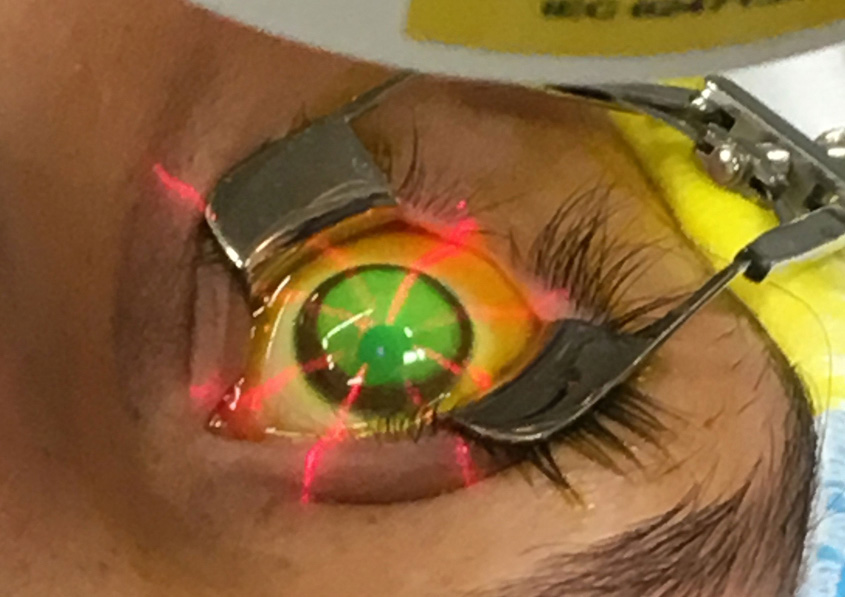 An accelerated protocol for performing corneal collagen crosslinking, available internationally, showed good long-term safety and stability.