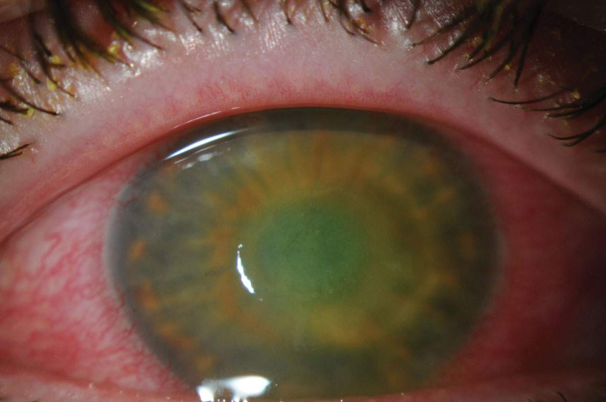 A total of 43 bacterial keratitis isolates were evaluated for their antibiotic resistance and susceptibility to the novel drug combination of polymyxin B/trimethoprim with rifampin. The study demonstrated the drug’s ability to eliminate all of the isolates tested, even the ones classified as multidrug-resistant. 