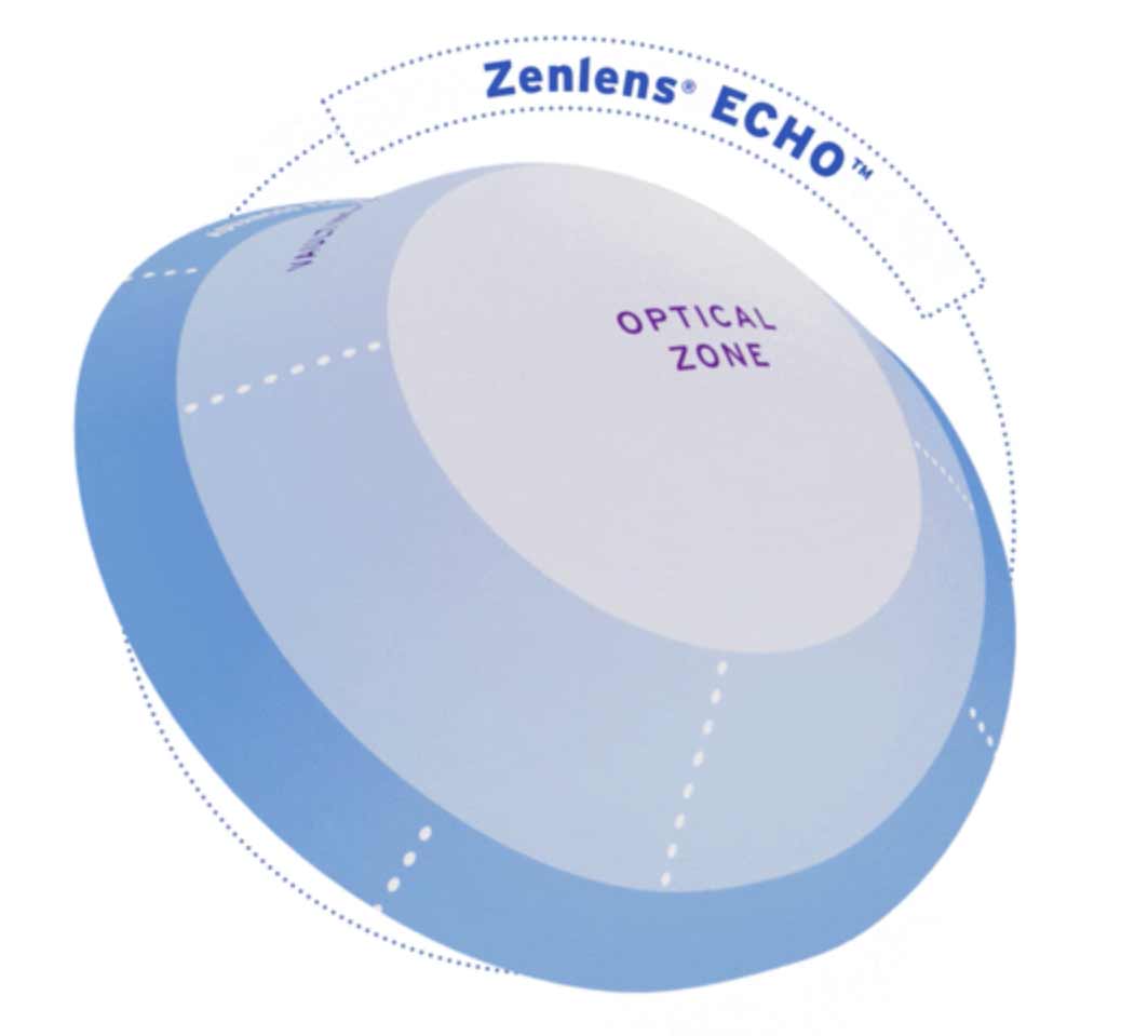The Zenlens Echo can be customized to fit patients with advanced corneal conditions, the company says.