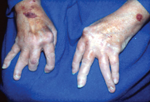 rheumatoid arthritis zsibbadt kar