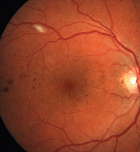 diabetic edema eye a kezelés a cukorbetegség terhelés