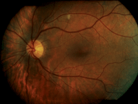 venous stasis retinopathy carotid endarterectomy
