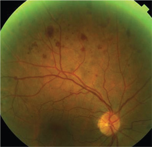 venous stasis retinopathy vs ocular ischemic syndrome)