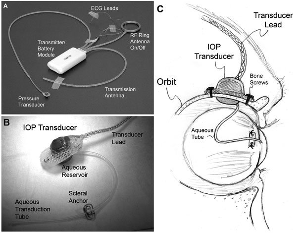 Mean amplitude of intraocular pressure excursions: a new