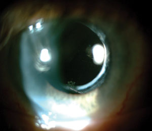 Post Cataract Surgery Dysphotopsias