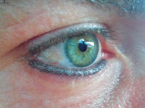 The Dangers of Eyelid Tattooing