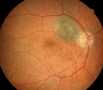 A Clinical Guide to Fundus Autofluorescence