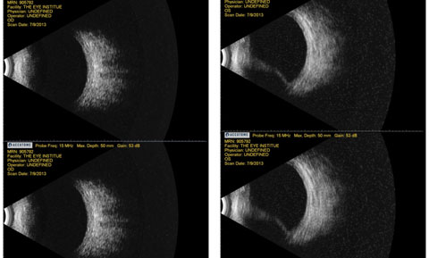 Fig. 1. Above, this B-scan ultrasonography shows test results from a patient who complained of diminished vision for a week. She had recently had a drainage valve implanted to help with her glaucoma. 