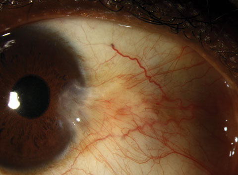 An Atlas of Conjunctival and Scleral Anomalies
