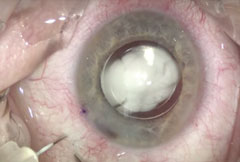 A transzonluar injection of TriMoxi after cataract surgery.