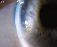 macular edema after cataract surgery symptoms