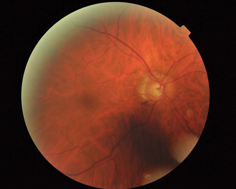 This teleretinal photograph demonstrates a highly suspicious case of glaucoma in the patient’s right eye. Despite the shadow, there is obvious rim thinning inferiorly with an adjacent Drance hemorrhage. 