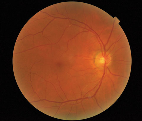 This teleretinal image shows a retinal plaque in the superotemporal arcade at the second bifurcation. The patient was examined in clinic and an additional plaque was noted along the inferotemporal artery. A carotid duplex revealed 80% to 99% stenosis in the right internal carotid artery. The patient underwent a successful carotid angioplasty and stenting to relieve the stenosis. 