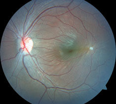 Do these fundus photographs provide any explanation for our patient’s blurred vision?