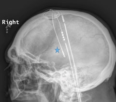 Figs. 3 and 4. Radiographs of the skull with two deep brain stimulators within the cranium notated adjacent to the blue stars.