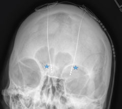 Figs. 3 and 4. Radiographs of the skull with two deep brain stimulators within the cranium notated adjacent to the blue stars.