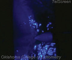 The bright, almost neon blue in this slit lamp image shows the fluid pulsing around the wound.