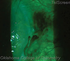 In this patient’s case, a conjunctival vessel was broken, resulting in the black fluid.
