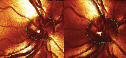 Fig. 1. This image shows the contours of the right optic nerve. Note the change in the neuroretinal rim in the inferotemporal aspect between the baseline (left) and the conversion image (right).
