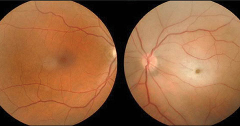 This patient presented to the ED with vision loss in the right eye.