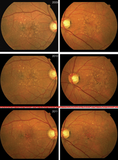 Color fundus images of a 63-year-old man with AMD and large soft drusen and drusneoid pigment epithelial detachments. 