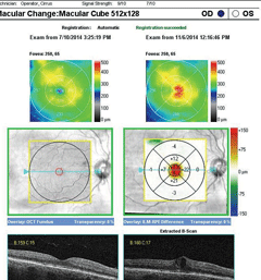 SD-OCT macular change analysis  demonstrating the development of DME over a period of less than four months.