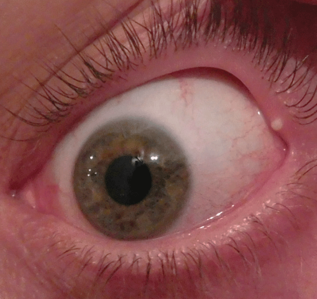 My Eyelid Hurts, Do I Have a Stye? - Optometrists Near You