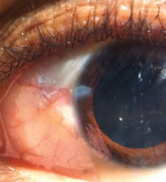This 27-year-old patient presented with ocular discharge. He says his eyes became red following a cold. Can you explain what’s causing his symptoms?