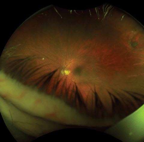 Fig. 1. An 82-year-old asymptomatic male with an old self-sealing horseshoe retinal tear.