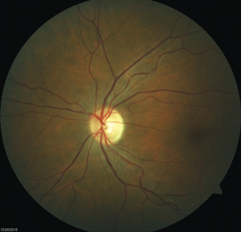 Fig. 2. Fundus images of the patient’s left and right eyes, respectively, which revealed mild bitemporal optic nerve pallor