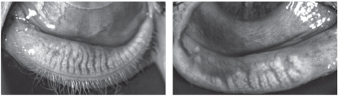 At left: Relatively healthy meibomian glands with piano-key like linear glands running the length of the eyelid. At right: Severe MG drop-out and dilation of the ductal tissues.