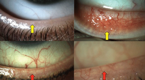 Contrast the normal appearance of the lids above with the telangiectasia, posterior dragging and loss of anatomical detail in the lower images (red arrows) in obstructive MGD.