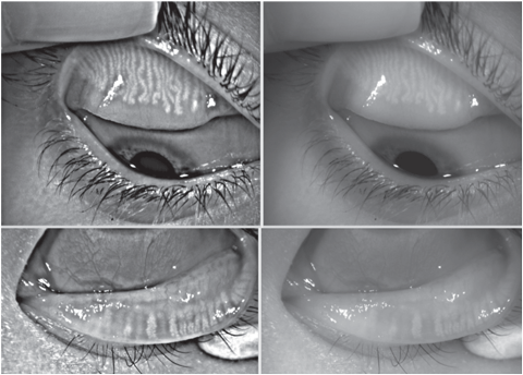 The reflected IR images (left) and white light images (right) in a patient with MG attenuation and drop-out. 