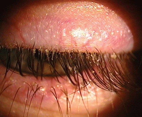 Blepharitis is an inflammatory infection that can lead to dry eye disease. Several products on the market aim to treat this condition.