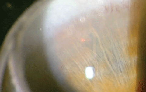 The clinician aims the laser directly to the left of the visible vessel to assure the laser doesn’t cause bleeding.