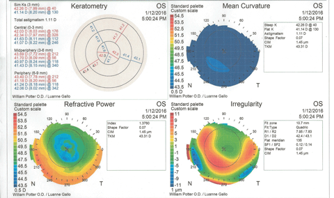Fig. 3. Post-removal corneal topography shows distortion and some inferior corneal steepening that could be misinterpreted as keratoconus.