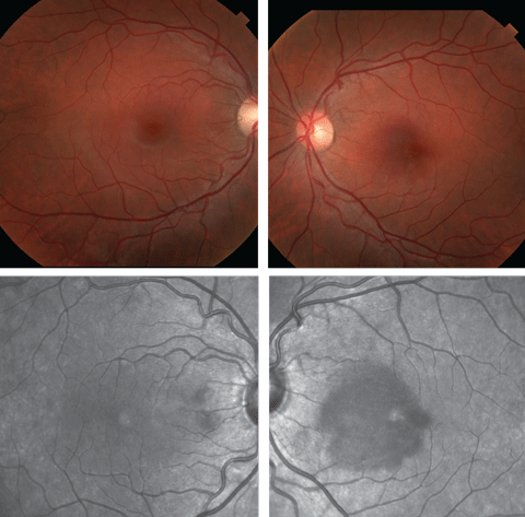 At top, fundus photos of the right and left eye of our patient. Below are red-free versions.