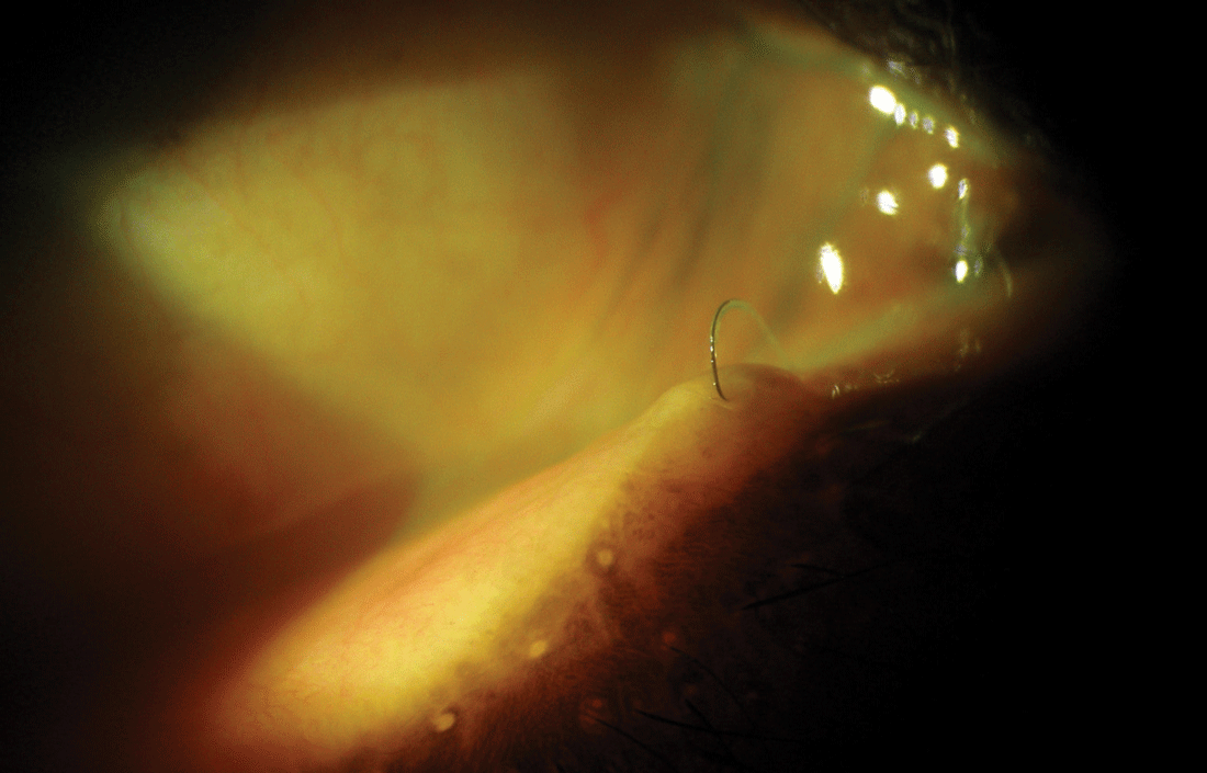 Can you tell what’s causing this patient’s ocular pain?