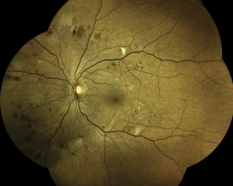 An Eidon True Color Confocal Scanner was used to image this PDR with an area of NVE at 10 o’clock. Below, this image shows a patient with mild nonproliferative diabetic retinopathy. Note the three dot hemorrhages superior to the macula.