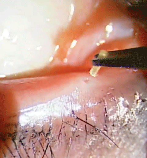 Collagen temporary plugs are inserted into the puncta using forceps. Technically, this is an intracanicular plug.